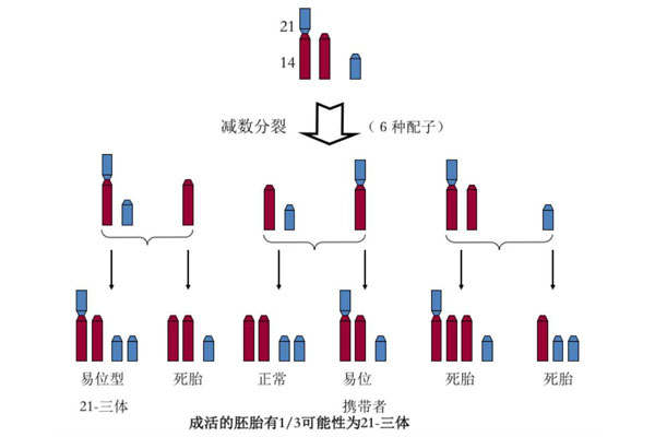 易位唐氏综合症